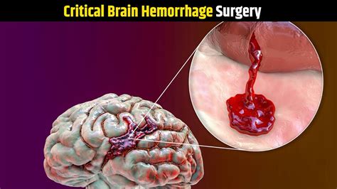 Critical Brain Hemorrhage Surgery Brain Hemorrhage Operation Mad