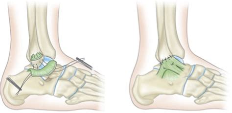 Cosm Lateral Ligament Reconstruction