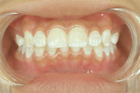 White Spots On Teeth Causes Treatment And Prevention