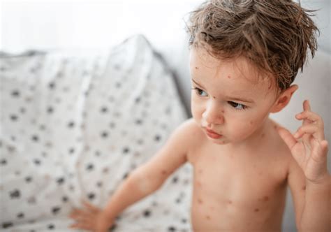 First Aid Handbook Chickenpox Integrity Urgent Care