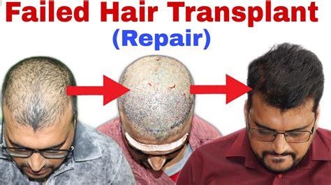A Failed Hair Transplant Case Repaired By Regrow Clinic Best Results