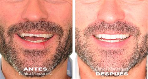 Tratamiento Bruxismo con Ortodoncia Invisalign - Clínica Manzanera