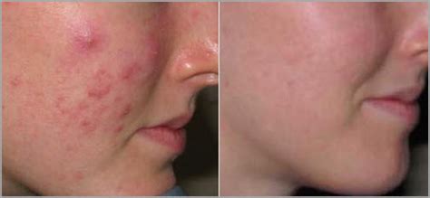 Microdermabrasion Peels And Specialty Spa Treatments