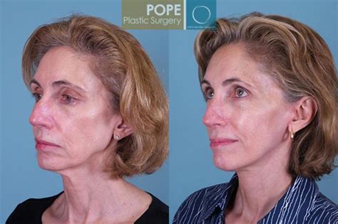 Facelift Before And After Pictures Case 144 Orlando Fl Pope