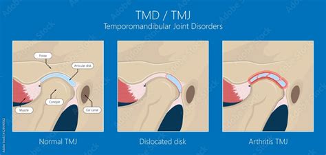 Temporomandibular Joint Disorders Tmd Tmj Jaw Temporal Bones Muscles