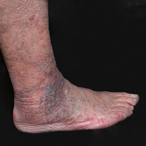 If Vein Disease Is Left Untreated People May Experience The Painful