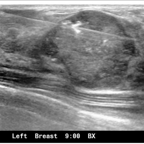A 25 Year Old Female With Dcis In Fibroadenoma Ultrasound Examination