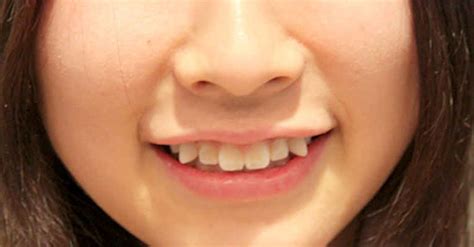 Por Qual Motivo Os Dentes Yaeba São Tão Populares No Japão