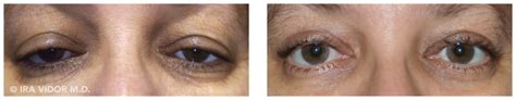 Ptosis Surgery Before And After Gallery Dr Ira Vidor