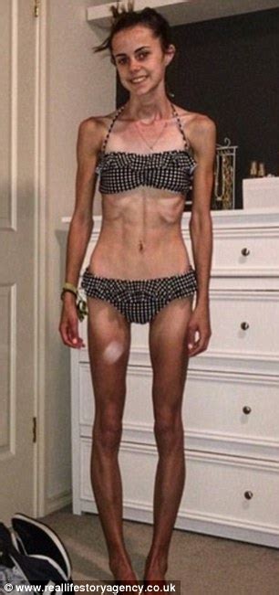 Blogger Documents Her Anorexia Recovery With Before And After Photos On