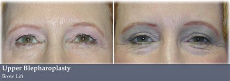 Eye Lid Lift Vargas Face And Skin Center