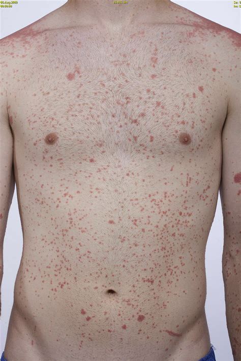 Diagnosis And Management Of Psoriasis In Children Pediatric Clinics