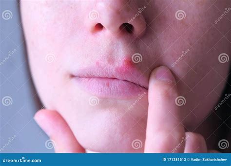 Herpes Virus On Human Lips Woman Touching Herpes Sore On Lip Mouth