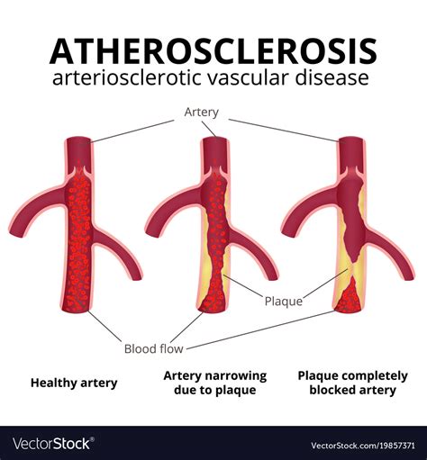 Coronary Artery Disease Royalty Free Vector Image
