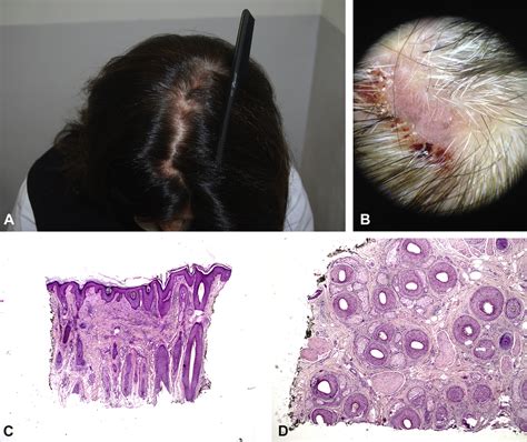 Erosive Pustular Dermatosis Of The Scalp Clinical Trichoscopic And
