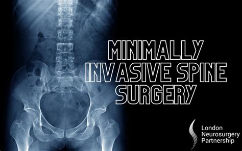 Minimally Invasive Spine Surgery London Neurosurgery