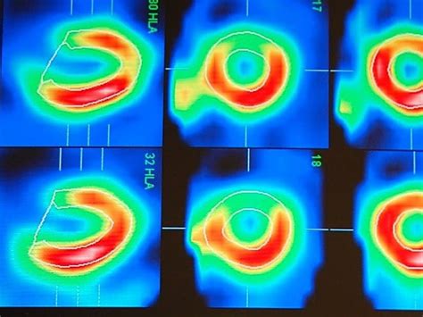 Study Describes Rise And Fall Of Nuclear Cardiac Imaging Test