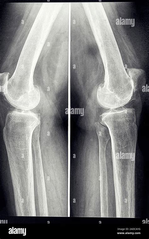 Sagittal X Ray Of The Knees Of A 72 Year Old Female With Osteoarthritis