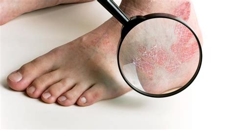 Psoriasis Why Is It Such A Nuisance To Deal With Podiatry Hq