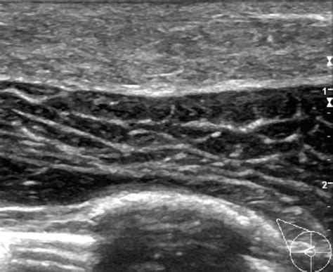 Ultrasound Of The Subareolar Region Of The Right Breast In The Radial
