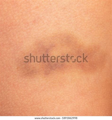 Hematoma On Skin Leg Background Stock Photo 1891862998 Shutterstock