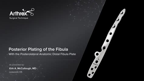Arthrex Posterior Plating Of The Fibula With The Posterolateral