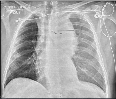Blunt Thoracic Aortic Injury Resulting In Free Rupture Into The Pleural