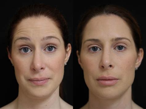 Compare Botox Xeomin And Dysport And You See Similar Results