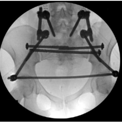 Intra Op Fluoroscopic Image After Application Of Bilateral Triangular