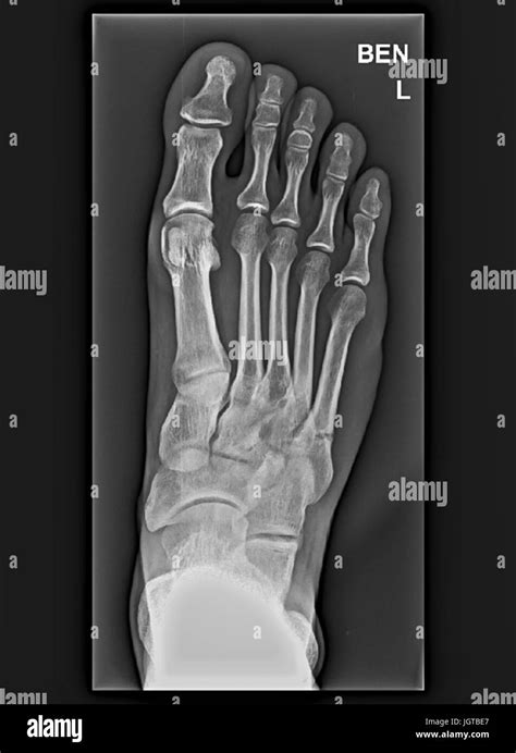 Foot Xray Stock Photos And Foot Xray Stock Images Alamy