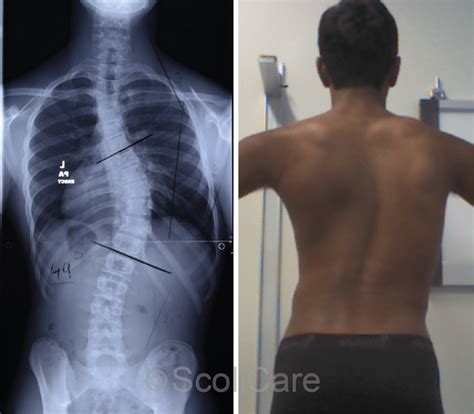 Understanding Scoliosis What Causes It And How Is It Treated Becker