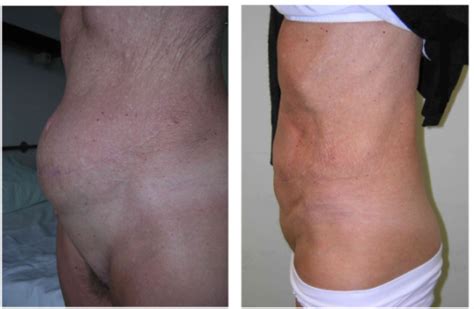 Abdominal Contour Before And After Reconstruction A Open I