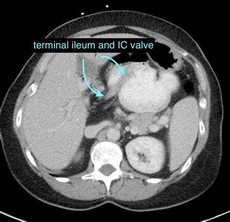 Foramen Of Winslowlesser Sac Internal Hernia Containing Cecum And