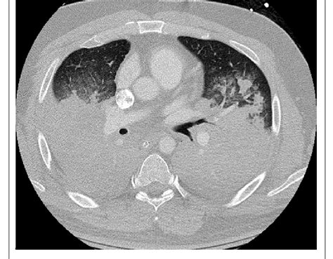 Hospital Day 1 Anterior Posterior Chest X Ray Demonstrating Widespread