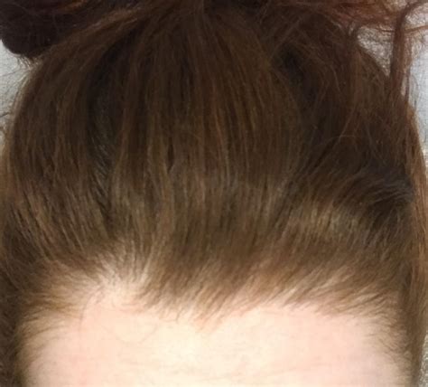 Does Anyone Know What Causes This Bald Spot In My Hairline Its There