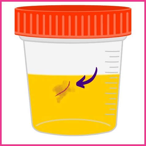 5 Main Causes Of Worm Like Blood Clots In Urine Drexplains