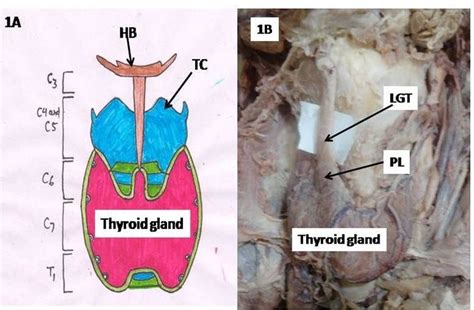 Pyramidal Lobe Thyroid Ultrasound