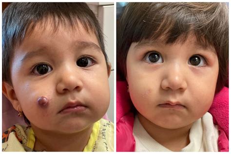 New York Hemangiomas Before And After Photos Los Angeles