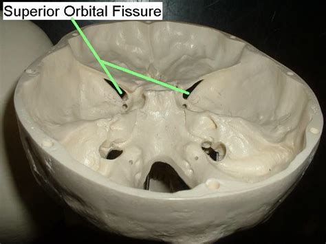 Superior Orbital Fissure One Part Of Sphenoid Bone Health Science