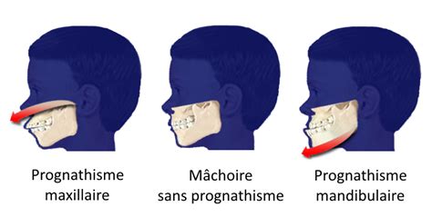 Mandibule — chez les vertébrés, la mandibule forme la mâchoire inférieure et s articule avec le crâne au niveau de l articulation mandibulaire. File:Prognathism3-fr.png - Wikimedia Commons