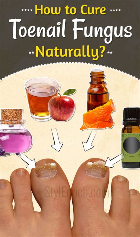 How To Cure Toenail Fungus Naturally Sports Health And Wellbeing