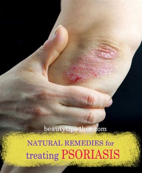 8 Natural Remedies For Treating Psoriasis Beauty And Makeup Tips Treat Psoriasis Natural