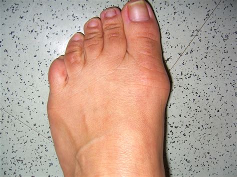 The Art Of Bunion Surgery Everyones Guide For Great Results Do I