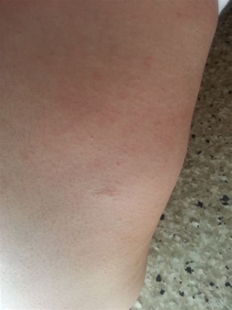 Does hsv2 first outbreak may look like a normal rash, or ulcers (or blisters, or papules) are seen from the begining of the outbreak itching starts? answered by dr. Hi Doctor, i have a question about a rash that has appeared