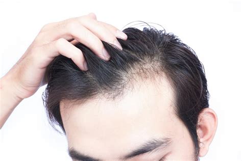Early Signs Of Hair Loss You Shouldn T Ignore Suntrics