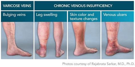 Venous Disease