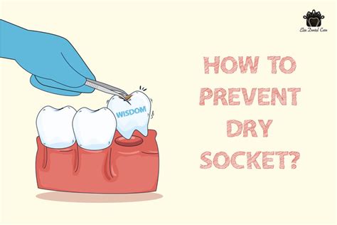 Pulled Out Wisdom Teeth How To Prevent Dry Socket Elite Dental Care Tracy