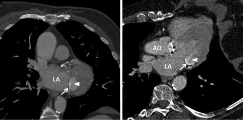 Figure 3 From Multimodality Cardiac Imaging In The Evaluation Of Mitral