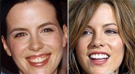 You see, a bad bite occurs when the top jaw and bottom jaw don't align properly. 25 best images about Celebrity Smile Makeovers on Pinterest