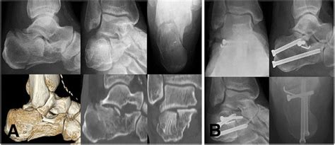 Radiologic Evaluations Of A 55 Year Old Male Patient With Sanders